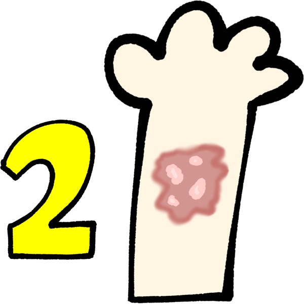 A pale white arm with a yellow 2 next to it. The arm has a slightly darker pale red blotch on it with lighter blisters.